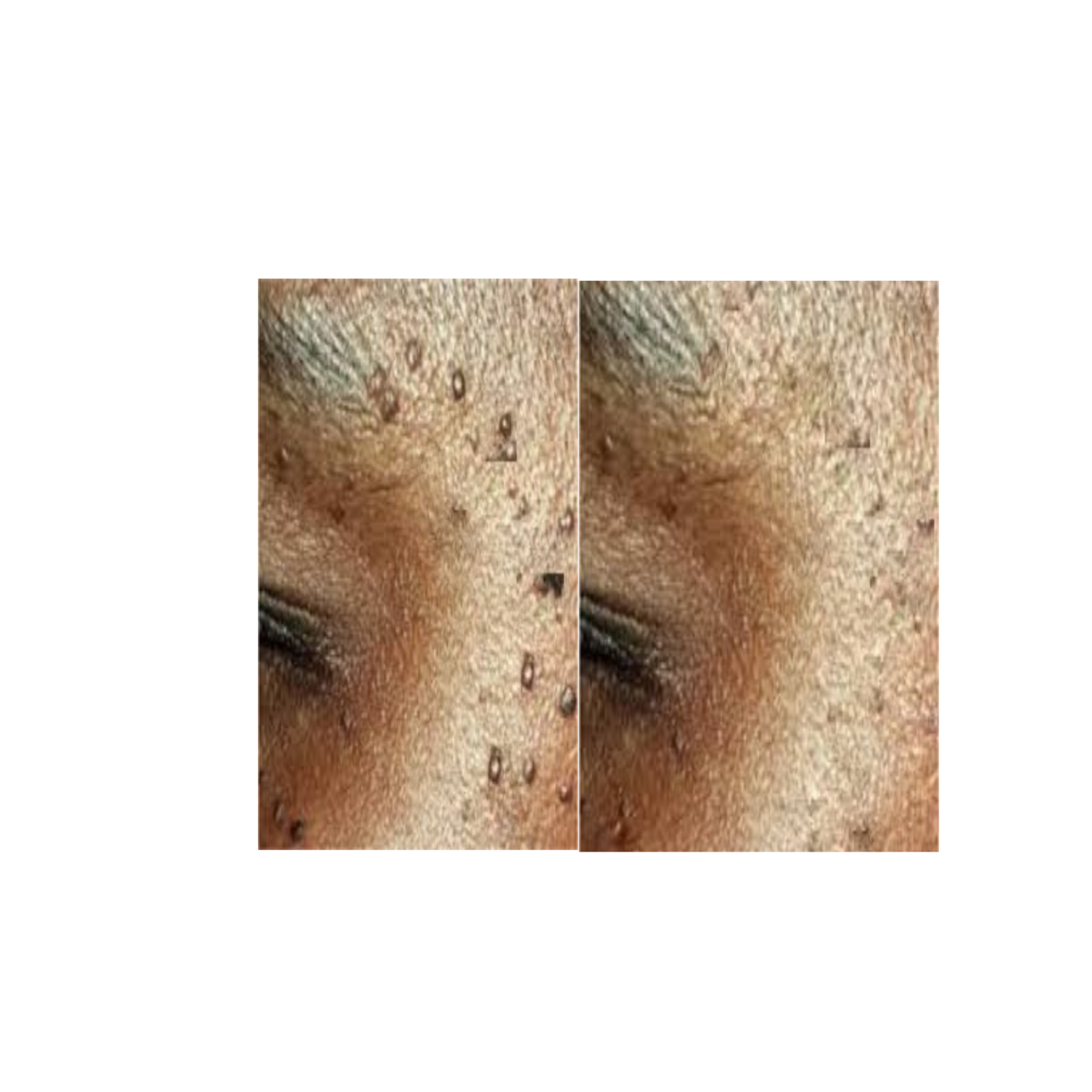 Photo of face with benign epidermal growth that presents as DPN (dermatosis papulosa nigra) for which Minimize Glycolic Acid Exfoliating Serum for non-sensitive, normal-to-oily skin by Uniquely Effective Skincare is suitable